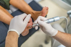 Corns and Calluses, Their Treatment