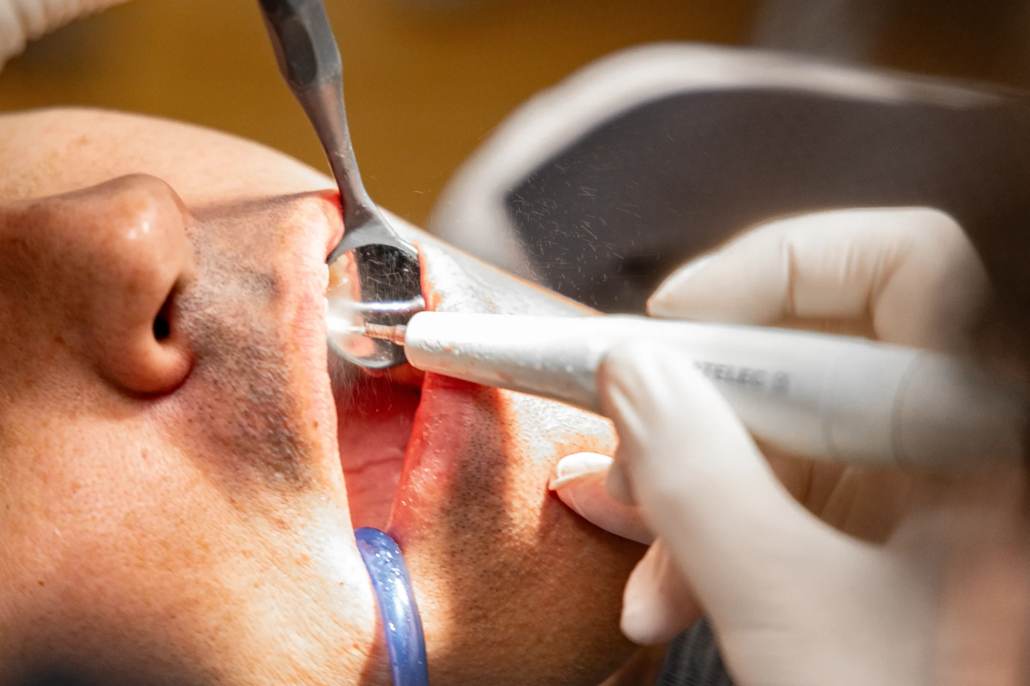 Sensibilidad dental, que lo causa y que tratamientos tenemos